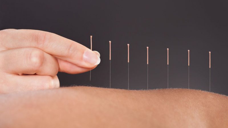 Você sabe o que é Agulhamento a Seco (Dry Needling)?